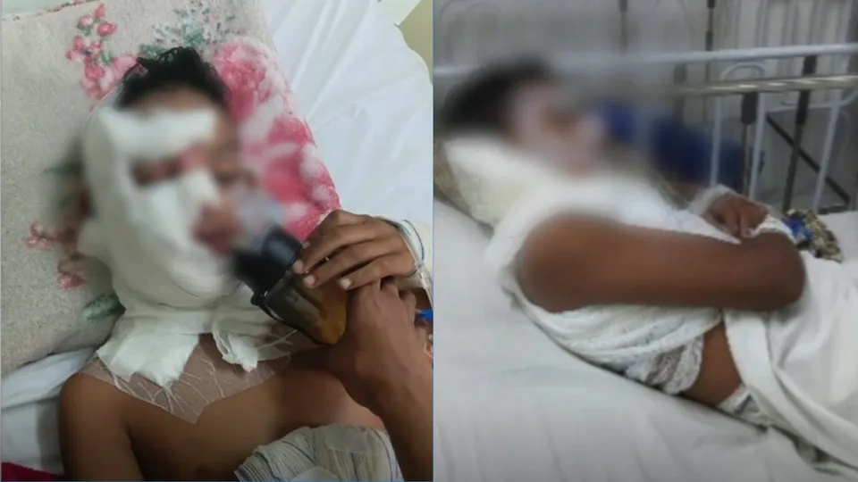 Menino de 11 anos sofre queimaduras após acidente com gasolina em Macaíba